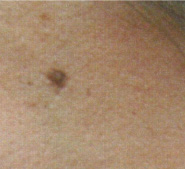 炭酸ガスレーザー たかお皮フ科クリニック 一般皮膚科 美容皮膚科 島根県松江市